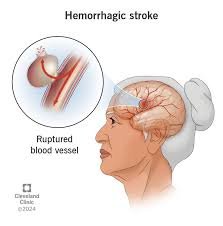 hemorrhagic stroke