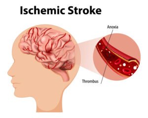 ischemic-stroke