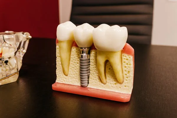 Maintain Your Dental Implants